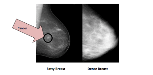 Mammograms and dense breast tissue