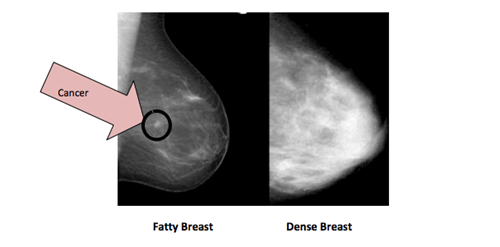 What Does It Mean To Have Dense Breast Tissue What Does It Mean To Have Dense Breast Tissue