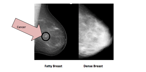 What Does it Mean to Have Dense Breast Tissue?